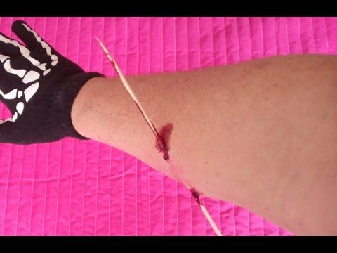 Broma genial - Brazo herido!!!