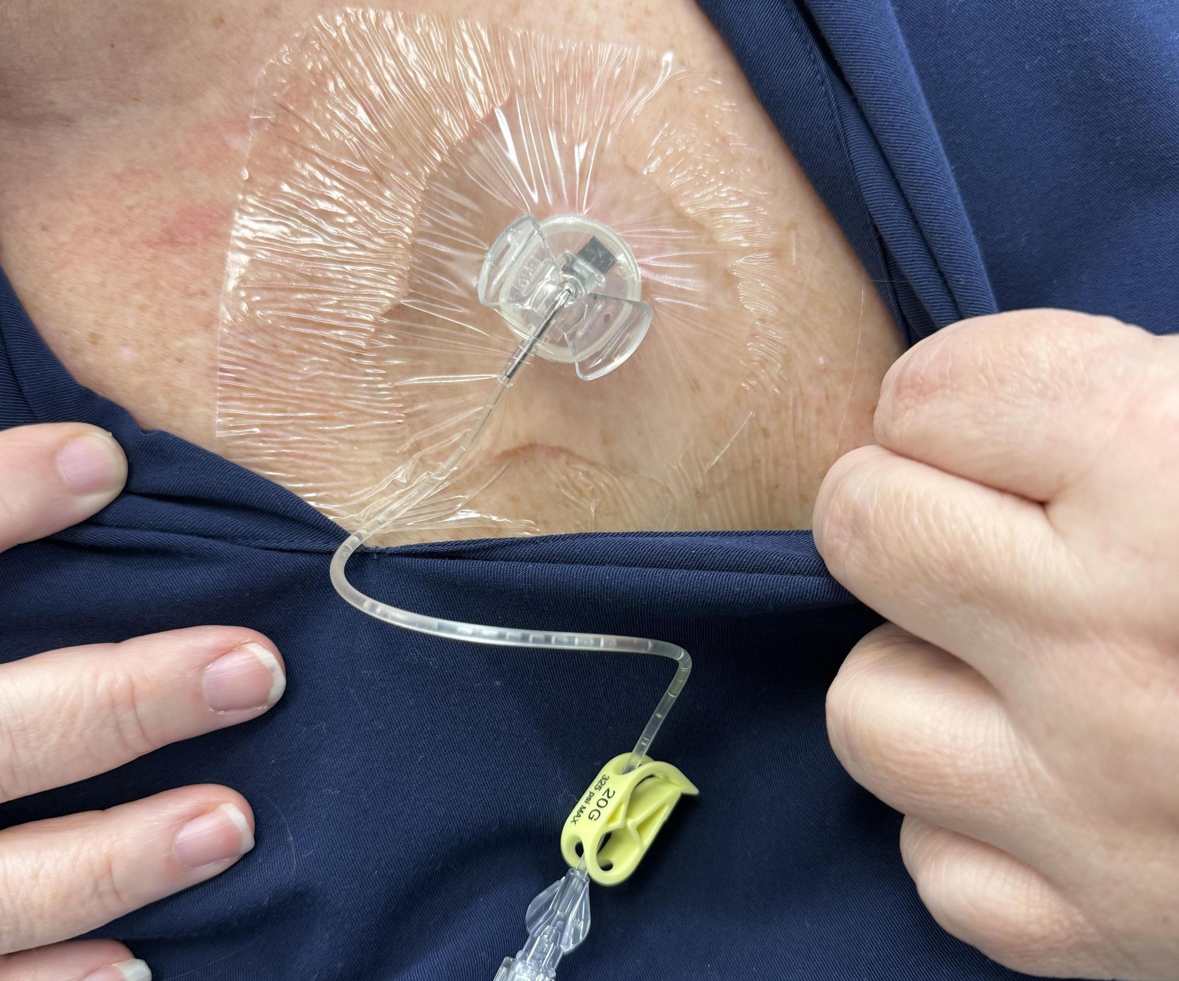 How to De-access a Chemotherapy Port After Infusion